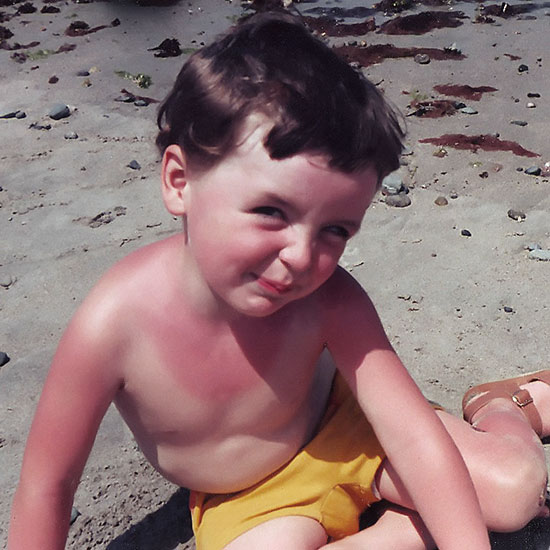 Kind mit Sonnenbrand