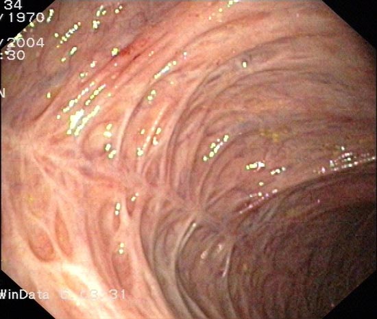 Narbenstadium einer Colitis ulcerosa