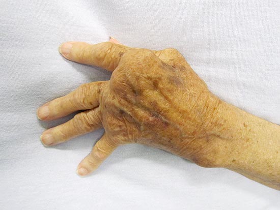 Rheumatoide Arthritis an einer Hand