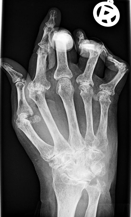 Rheumatoide Arthritis (Typisches Röntgenbild einer betroffenen Hand)