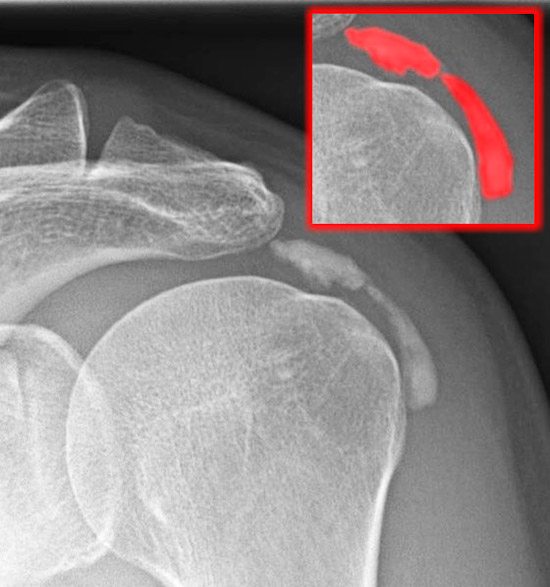 Röntgenbild einer verkalkenden Schleimbeutelentzündung der Schulter (Kalkdepot im Ausschnitt rot gefärbt)