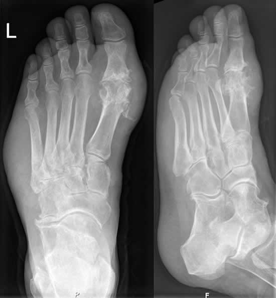 Gicht im Röntgenbild des Fußes. Typische (Haupt-)Lokalisation am Großzehengrundgelenk. Beachte auch die Weichteilschwellung lateral am Fußrand.