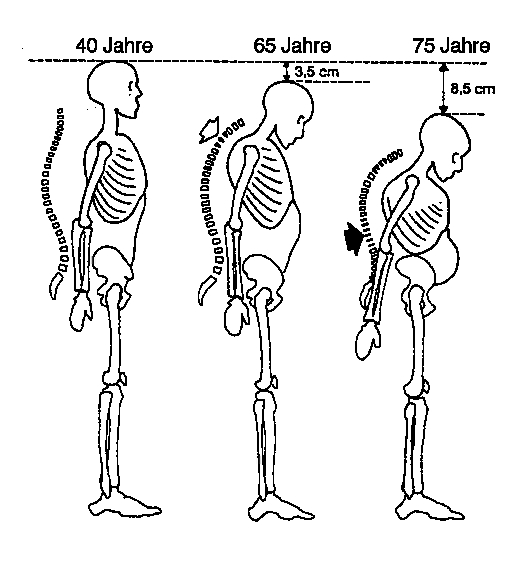 Schema des Körperhöhenverlusts bei Osteoporose