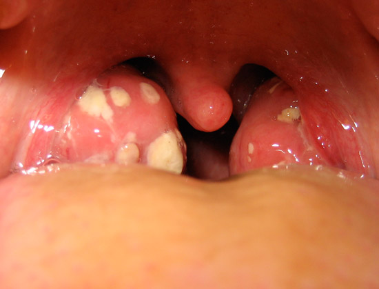 Mandelentzündung (Tonsillitis)